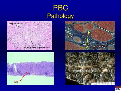 Ppt Primary Biliary Cirrhosis Pbc Powerpoint Presentation Free Download Id 216394