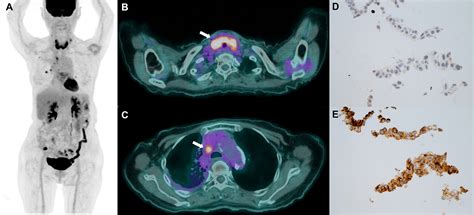 Thyroid Metastasis From Lung Adenocarcinoma Radiology Imaging Cancer