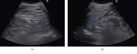 Figure From Autosplenectomy In A Patient With Paroxysmal Nocturnal