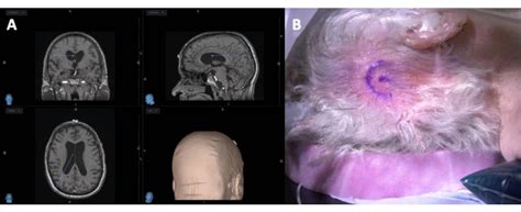 Neuronavigation And Laparoscopy Guided Ventriculoperitoneal Shunt