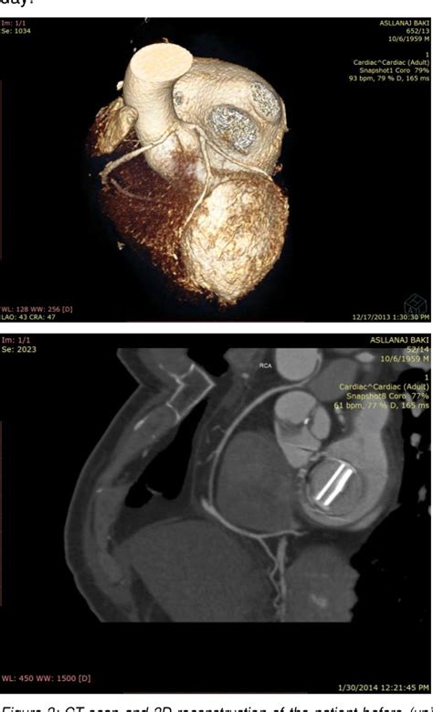 Figure From Surgical Treatment Of Anomalous Origin Of Right Coronary