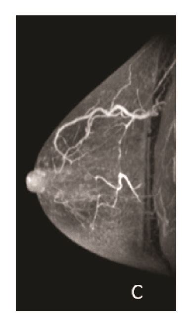 52 Year Old Woman Invasive Ductal Carcinoma With Pathologic Complete