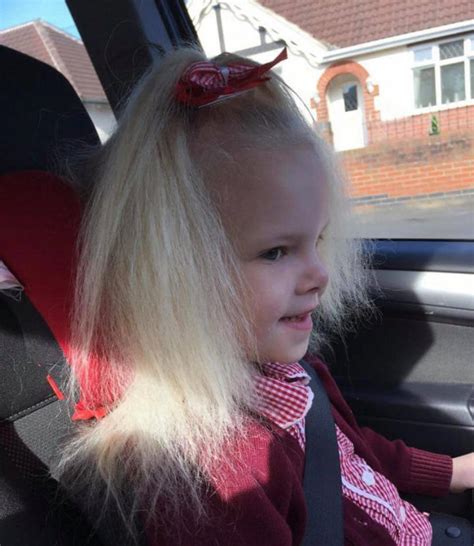 Uncontrollable Hair Syndrome: Girl, 9, finally able to have her hair brushed and styled