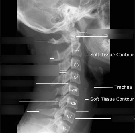 Lateral Anatomy Of Cervical Spine Diagram Quizlet