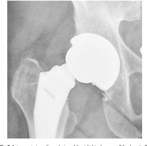 Figure 1 From Fractures Of A Single Design Of Highly Cross Linked Polyethylene Acetabular Liners