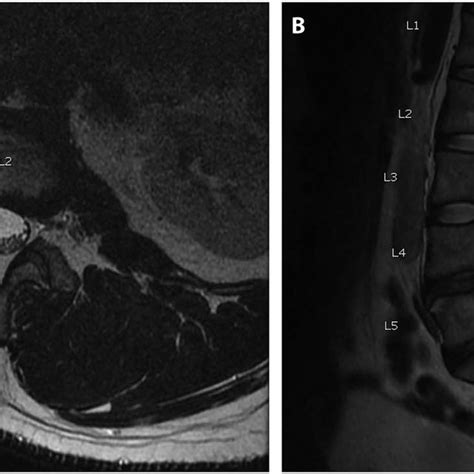 Axial A And Sagittal B T2 Mri Imaging Obtained Preoperatively When Download Scientific