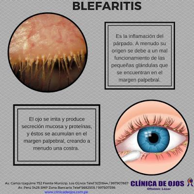 Cl Nica De Ojos Oftalmic L Ser Blefaritis