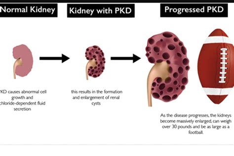 What Are the Causes of Kidney Disease? | Up Best Home