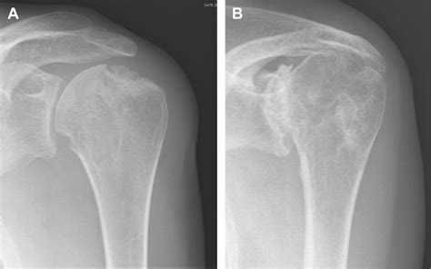 Conventional Radiology In Rheumatoid Arthritis Radiologic Clinics