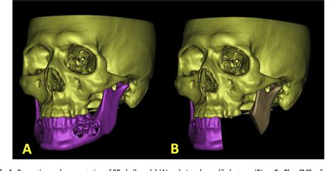 Figure 1 From Improving The Accuracy Of Mandibular Reconstruction With Vascularized Iliac Crest