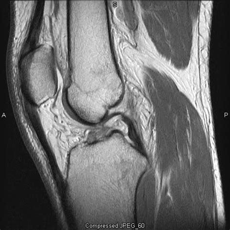 mri procedures and pathology: ACL Tear