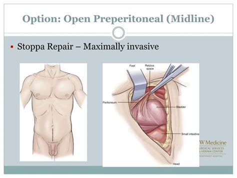 Laparoscopic Vs Open Inguinal Hernia Repair