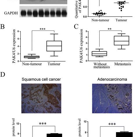 Expression Of PAK4 And The Association With Progression In NSCLC A