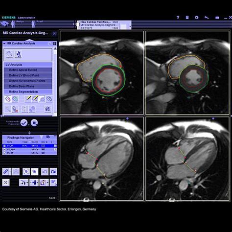 Syngo MR Cardiac 4D Ventricular Function Siemens Healthineers USA