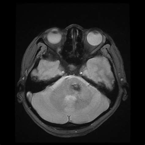 Cavernoma With Developmental Venous Anomaly Image Radiopaedia Org