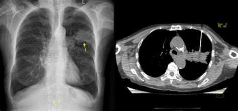 Image Guided Biopsy Radiology At St Vincents University Hospital