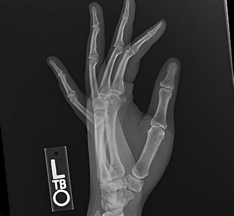 Sesamoid Fracture Of Left Thumb Image Radiopaedia Org