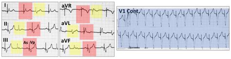 Pacemaker Mediated Tachycardia Resources