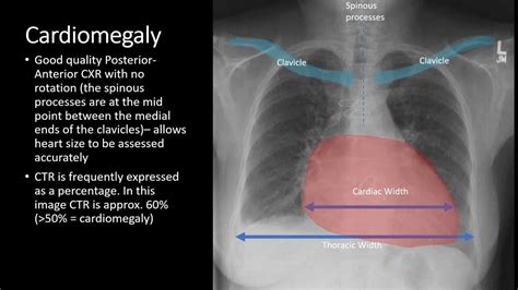 Chest X Ray Cardiac Pathologies Radiology Medical Education Rscp