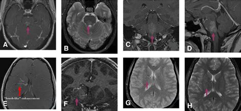 Capillary Telangiectasia A Mri Of The Brain Axial T W With