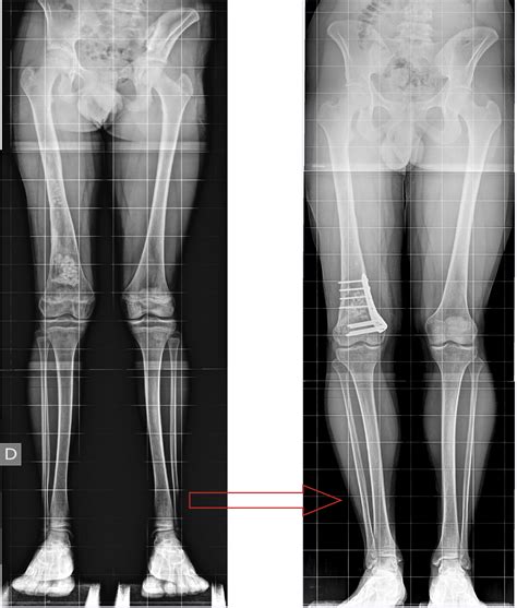 Osteomielitis Post Traumática Del Fémur En Un Paciente Pediátrico Con