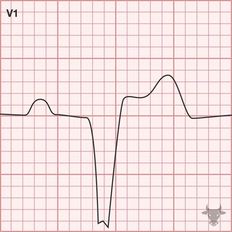 Glossary Ecg Stampede