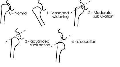 Shoulder Subluxation - Treatment, Exercises, Surgery