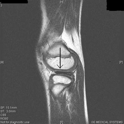 Discoid Lateral Meniscus Mri Sumers Radiology Blog