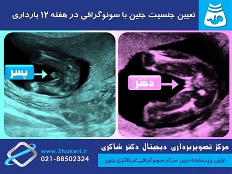 سونوگرافی تعیین جنسیت جنین در هفته 12 بارداری مرکز تصویربرداری دکتر شاکری