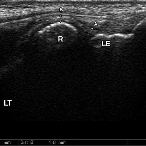 Sonography Of The Lateral Ulnar Collateral Ligament Of The Elbow Study