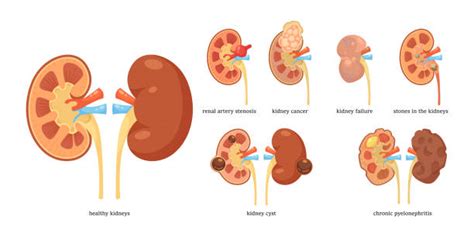 Kidney Cyst Symptoms Stock Photos, Pictures & Royalty-Free Images - iStock