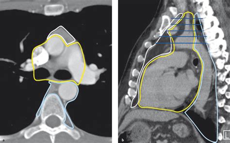 Mediastinum Radiology Key