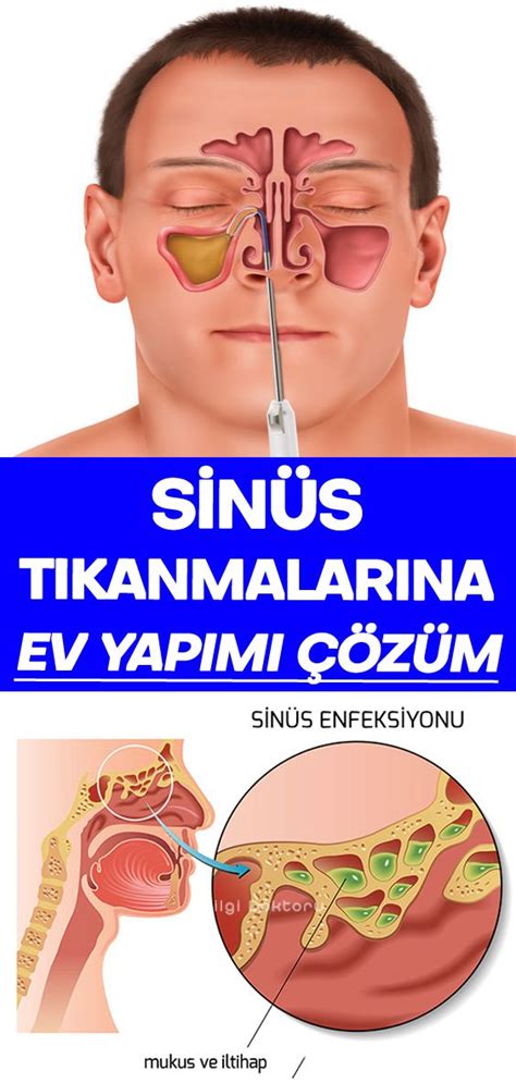 Sin Zit Ba A R S Nas L Ge Er Evde