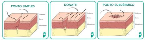 Resumo De Sutura Tipos Indica Es E Mais
