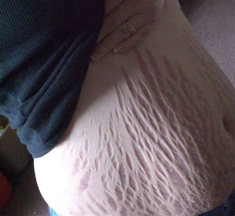 Insane Stretch Marks Gag