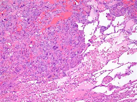 Large Cell Carcinoma of the Lung