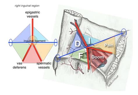 Tri Ngulo Inguinal