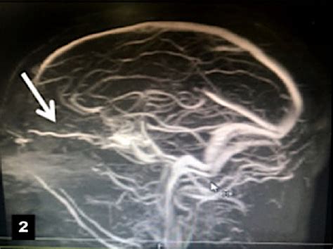 Septic Cavernous Sinus Thrombosis Secondary To Halo Vest Pin Site Infection North American