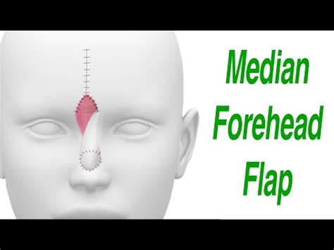 Median Forehead Flap For Nasal Defect Reconstruction Youtube