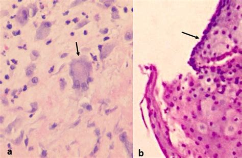 High Power Micrographs With H E Stain Of Specimens From Case A And