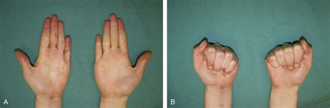 9: Staged Flexor Tendon Reconstruction | Clinical Gate