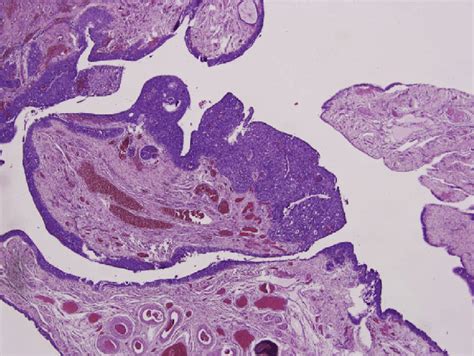 Hematoxylin And Eosin 40Â Stain Shows Partial Involvement Of The Download Scientific Diagram