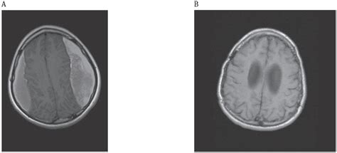 Recurrent Chronic Subdural Hematoma Report Of 13 Cases