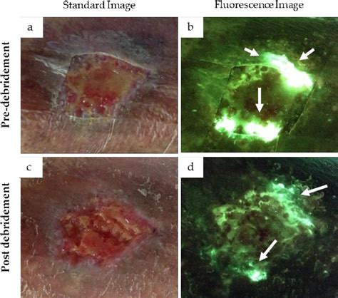 Figure 4 From Rapid Diagnosis Of Pseudomonas Aeruginosa In Wounds With