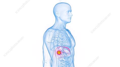 Animation of hepatic carcinoma in a human male - Stock Video Clip ...