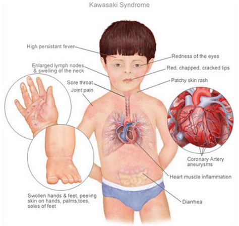 1 Minute Read Kawasaki Disease Delay In Diagnosis Is Common