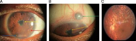 Anterior Uveitis Sarcoidosis