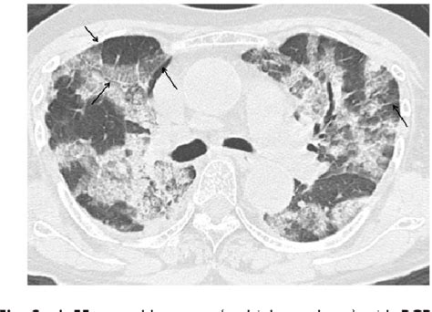 Figure 1 From The Usefulness Of A Diagnostic Method Combining High Resolution Ct Findings And