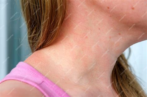 Dermatitis Alérgica En La Piel Del Cuello De La Mujer Enfermedad De La