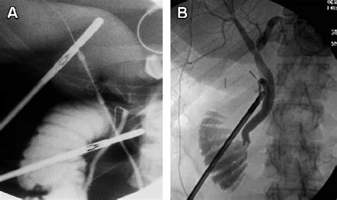 A Intraoperative Cholangiogram Taken When The Cholangiocatheter Is In